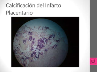 Calcificación del Infarto
Placentario
 