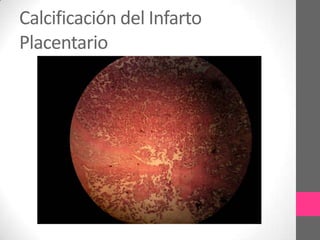 Calcificación del Infarto
Placentario
 