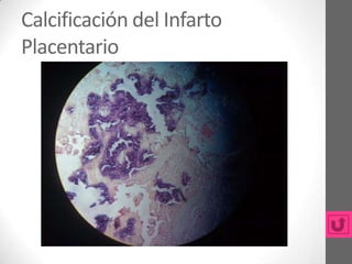 Calcificación del Infarto
Placentario
 