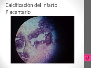 Calcificación del Infarto
Placentario
 