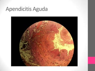 Apendicitis Aguda
 