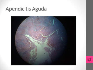 Apendicitis Aguda
 