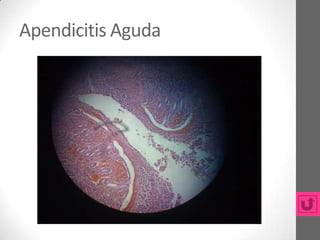 Apendicitis Aguda
 
