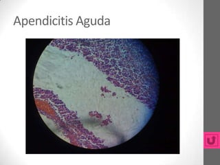 Apendicitis Aguda
 