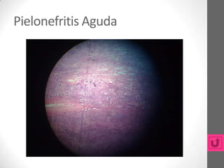 Pielonefritis Aguda
 