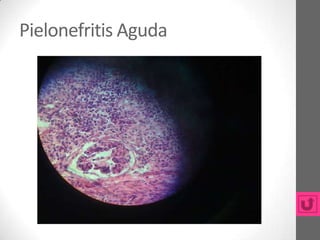 Pielonefritis Aguda
 