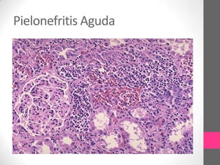 Pielonefritis Aguda
 