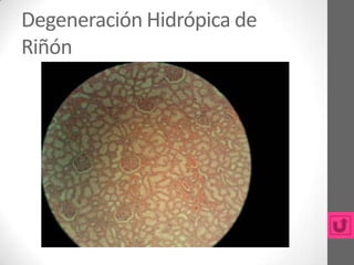 Degeneración Hidrópica de
Riñón
 