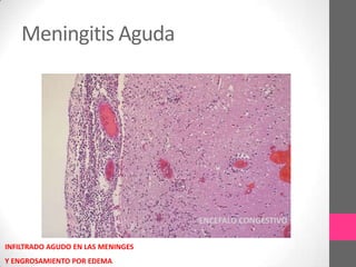 Meningitis Aguda




                                   ENCEFALO CONGESTIVO

INFILTRADO AGUDO EN LAS MENINGES
Y ENGROSAMIENTO POR EDEMA
 