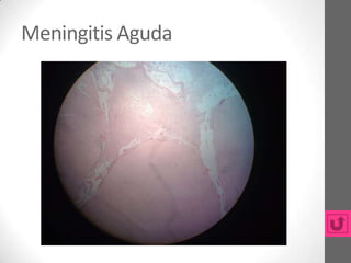 Meningitis Aguda
 
