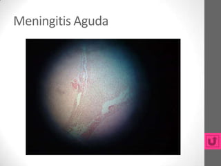 Meningitis Aguda
 