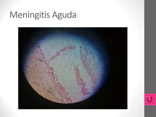 Meningitis Aguda
 