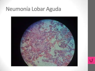 Neumonía Lobar Aguda
 