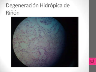 Degeneración Hidrópica de
Riñón
 