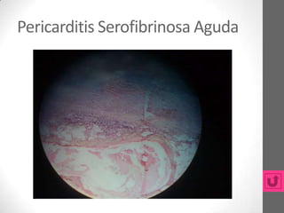 Pericarditis Serofibrinosa Aguda
 