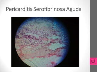Pericarditis Serofibrinosa Aguda
 