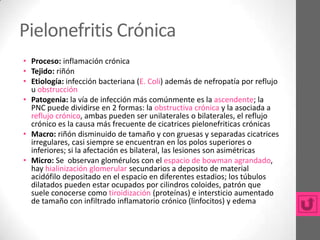 Pielonefritis Crónica
• Proceso: inflamación crónica
• Tejido: riñón
• Etiología: infección bacteriana (E. Coli) además de nefropatía por reflujo
  u obstrucción
• Patogenia: la vía de infección más comúnmente es la ascendente; la
  PNC puede dividirse en 2 formas: la obstructiva crónica y la asociada a
  reflujo crónico, ambas pueden ser unilaterales o bilaterales, el reflujo
  crónico es la causa más frecuente de cicatrices pielonefriticas crónicas
• Macro: riñón disminuido de tamaño y con gruesas y separadas cicatrices
  irregulares, casi siempre se encuentran en los polos superiores o
  inferiores; si la afectación es bilateral, las lesiones son asimétricas
• Micro: Se observan glomérulos con el espacio de bowman agrandado,
  hay hialinización glomerular secundarios a deposito de material
  acidófilo depositado en el espacio en diferentes estadios; los túbulos
  dilatados pueden estar ocupados por cilindros coloides, patrón que
  suele conocerse como tiroidización (proteínas) e intersticio aumentado
  de tamaño con infiltrado inflamatorio crónico (linfocitos) y edema
 