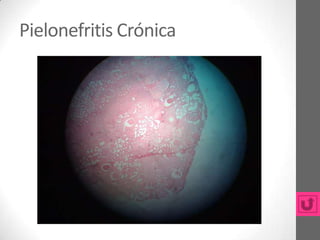 Pielonefritis Crónica
 