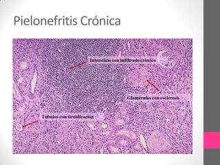 Pielonefritis Crónica
 