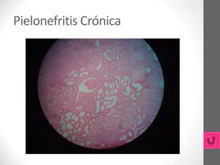 Pielonefritis Crónica
 