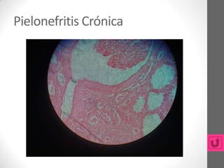 Pielonefritis Crónica
 