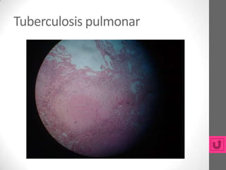Tuberculosis pulmonar
 