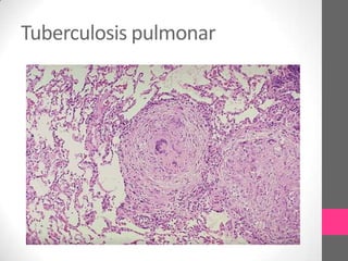 Tuberculosis pulmonar
 