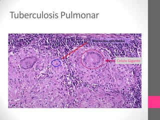 Tuberculosis Pulmonar



                        Celula Gigante
 