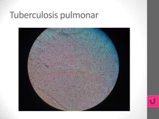 Tuberculosis pulmonar
 