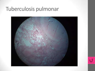 Tuberculosis pulmonar
 