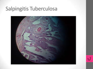 Salpingitis Tuberculosa
 