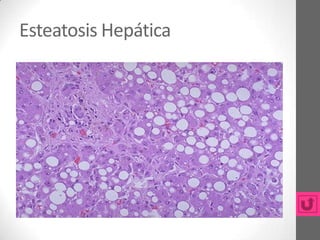 Esteatosis Hepática
 