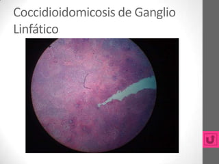 Coccidioidomicosis de Ganglio
Linfático
 
