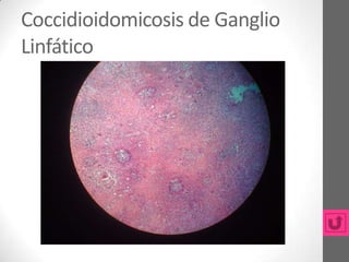 Coccidioidomicosis de Ganglio
Linfático
 