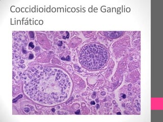Coccidioidomicosis de Ganglio
Linfático
 