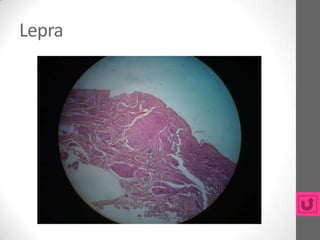 Lepra
 