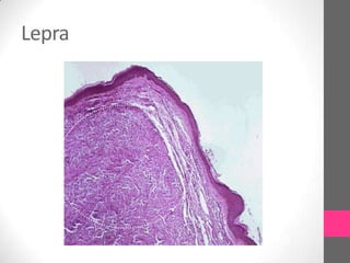 Lepra
 