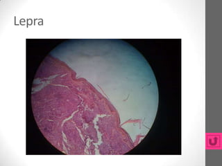 Lepra
 