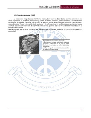 [UNIDAD DE CARDIOLOGÍA] Universidad de La Frontera



        H2. Resonancia nuclear (RNM)

       La resonancia magnética es una técnica inocua, bien tolerada. Esta técnica permite estudiar en una
única exploración la anatomía del corazón y valorar de forma cualitativa, semicuantitativa y cuantitativa los
parámetros de función cardíaca. Es útil para el estudio de las enfermedades valvulares, pericárdicas y
miocardiopatías. Aporta información de la anatomía y función cardíaca en cardiopatías congénitas complejas.
Además, con la administración de contraste intravenoso, permite conocer la viabilidad miocárdica en la
cardiopatía isquémica.
Nos permite ver realces en el miocardio que diferenciar tejido cicatrizial del viable. (Protocolos con gadolinio y
adenosina)




                                                     Figura 4. Insuficiencia mitral y tricúspide.
                                                     Plano de cuatro cámaras que muestra una zona
                                                     hipointensa adyacente a la válvula mitral
                                                     (flechas) y tricúspide (puntas de flecha) debido a
                                                     turbulencias
                                                     por flujo retrógrado durante la sístole ventricular
                                                     en relación con insuficiencia.




                                                                                                               12
 
