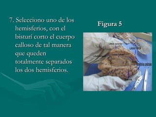 7. Selecciono uno de los
                             Figura 5
   hemisferios, con el
   bisturí corto el cuerpo
   calloso de tal manera
   que queden
   totalmente separados
   los dos hemisferios.
 