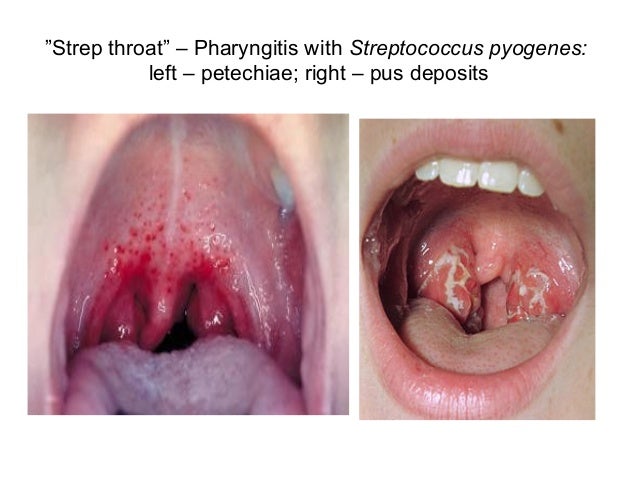 Strep throat pus