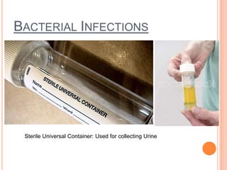 BACTERIAL INFECTIONS
Sterile Universal Container: Used for collecting Urine
 
