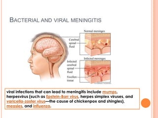 BACTERIAL AND VIRAL MENINGITIS
viral infections that can lead to meningitis include mumps,
herpesvirus (such as Epstein-Barr virus, herpes simplex viruses, and
varicella-zoster virus—the cause of chickenpox and shingles),
measles, and influenza.
 