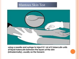 Mantoux Skin Test
using a needle and syringe to inject 0.1 ml of 5 tuberculin units
of liquid tuberculin between the layers of the skin
(intradermally), usually on the forearm
 
