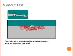 MANTOUX TEST
The induration (raised area) is what is measured.
NOT the erythema (red area).
 