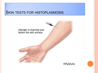 SKIN TESTS FOR HISTOPLASMOSIS
 