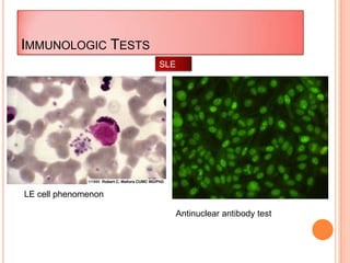IMMUNOLOGIC TESTS
LE cell phenomenon
Antinuclear antibody test
SLE
 
