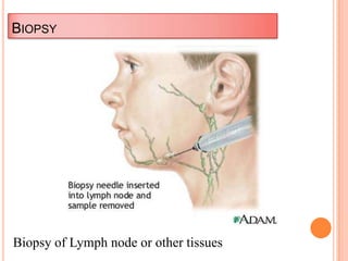 BIOPSY
Biopsy of Lymph node or other tissues
 