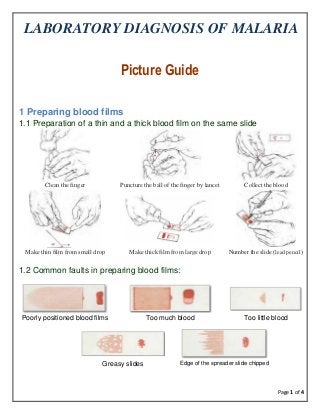 Page 1 of 4
LABORATORY DIAGNOSIS OF MALARIA
Picture Guide
1 Preparing blood films
1.1 Preparation of a thin and a thick blood film on the same slide
Clean the finger Puncture the ball of the finger by lancet Collect the blood
Make thin film from small drop Make thick film from large drop Number the slide (lead pencil)
1.2 Common faults in preparing blood films:
Poorly positioned blood films Too much blood Too little blood
Greasy slides Edge of the spreader slide chipped
 