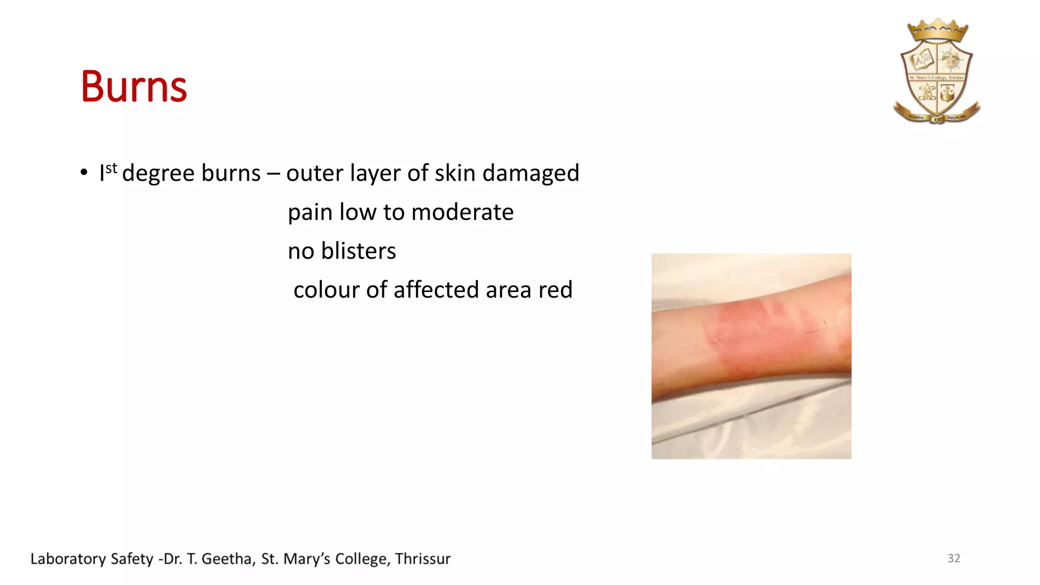 Burns
• Ist degree burns – outer layer of skin damaged
pain low to moderate
no blisters
colour of affected area red
32
 